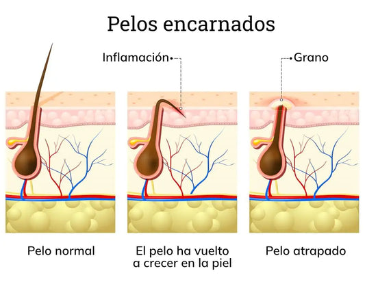 Cómo evitar y tratar los vellos encarnados al afeitarse.